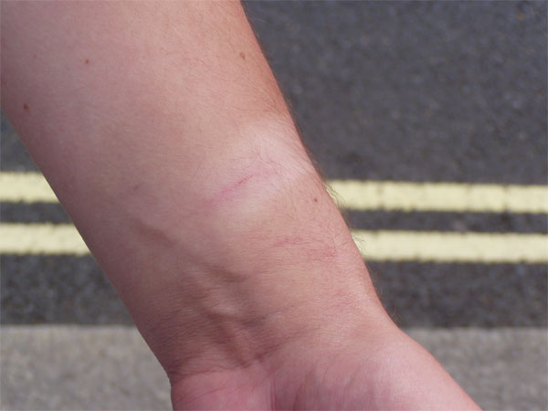 Arm With Cuts